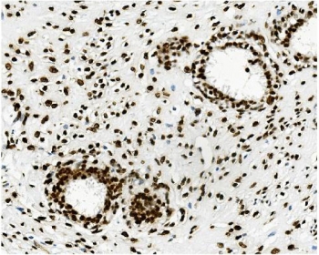 IHC staining of FFPE human breast cancer with TRIM28 antibody. HIER: boil tissue sections in pH8 EDTA for 20 min and allow to cool before testing.