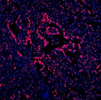 Immunofluorescent staining of FFPE human intestinal cancer with DDX5 antibody (red) and DAPI nuclear stain (blue). HIER: steam section in pH8 EDTA for 20 min.