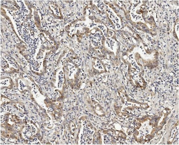 IHC staining of FFPE human rectal cancer with MMUT antibody. HIER: boil tissue sections in pH8 EDTA for 20 min and allow to cool before testing.