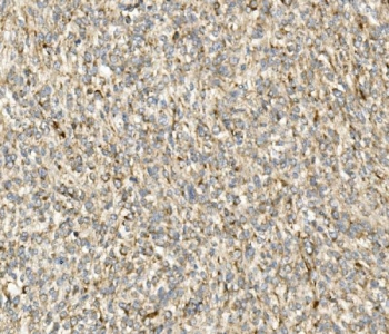 IHC staining of FFPE human renal cancer with CHOP antibody. HIER: boil tissue sections in pH8 EDTA for 20 min and allow to cool before testing.