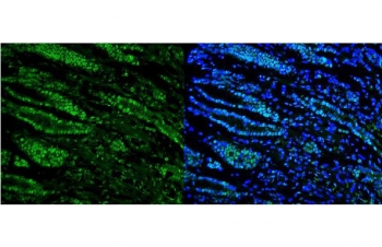 Immunofluorescent staining of FFPE human gastric cancer with RNA Helicase A antibody (green) and DAPI nuclear stain (blue). HIER: steam section in pH8 EDTA for 20 min.