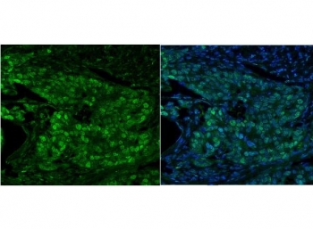 Immunofluorescent staining of FFPE human breast cancer with MCM5 antibody (green) and DAPI nuclear stain (blue). HIER: steam section in pH8 EDTA for 20 min.