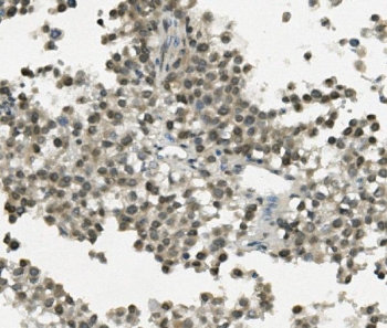 IHC staining of FFPE human testicular cancer with REC8 antibody. HIER: boil tissue sections in pH8 EDTA for 20 min and allow to cool before testing.