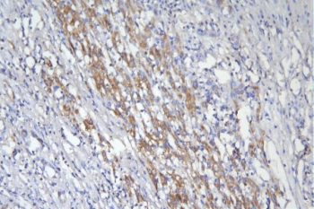 IHC staining of FFPE human liver cancer with CD46 antibody. HIER: boil tissue sections in pH8 EDTA for 20 min and allow to cool before testing.