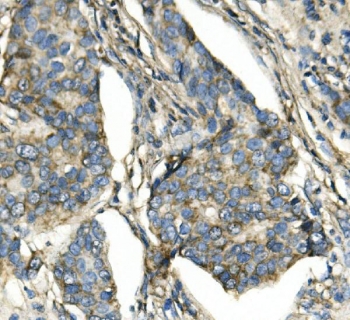 IHC staining of FFPE human breast cancer with ATP5H antibody. HIER: boil tissue sections in pH8 EDTA for 20 min and allow to cool before testing.