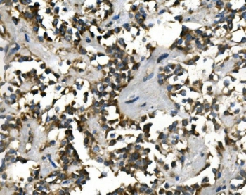IHC staining of FFPE human pancreatic cancer with VMAT1 antibody. HIER: boil tissue sections in pH8 EDTA for 20 min and allow to cool before testing.