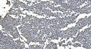 IHC staining of FFPE human testis cancer with GLRX2 antibody. HIER: boil tissue sections in pH8 EDTA for 20 min and allow to cool before testing.