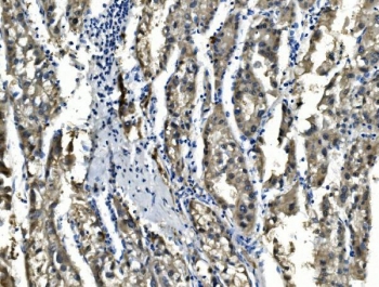 IHC staining of FFPE human liver cancer with SORD antibody. HIER: boil tissue sections in pH8 EDTA for 20 min and allow to cool before testing.
