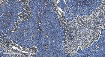 IHC staining of FFPE human lung cancer with GNG2 antibody. HIER: boil tissue sections in pH8 EDTA for 20 min and allow to cool before testing.