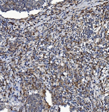 IHC staining of FFPE human lung cancer with NDUFB2 antibody. HIER: boil tissue sections in pH8 EDTA for 20 min and allow to cool before testing.