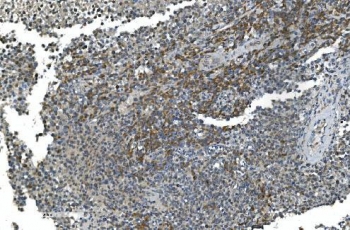 IHC staining of FFPE human testicular cancer with TIMM8A antibody. HIER: boil tissue sections in pH8 EDTA for 20 min and allow to cool before testing.