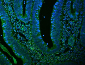 Immunofluorescent staining of FFPE human rectal cancer with FLNA antibody (green) and DAPI nuclear stain (blue). HIER: steam section in pH8 EDTA buffer for 20 min.