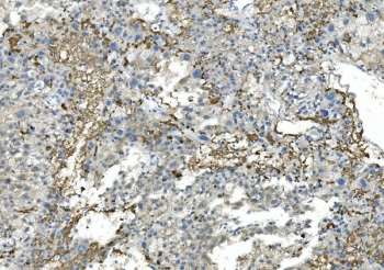 IHC staining of FFPE human liver cancer with FGB antibody. HIER: boil tissue sections in pH8 EDTA for 20 min and allow to cool before testing.