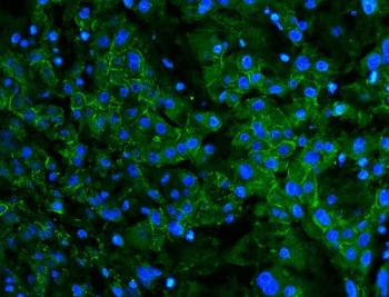 Immunofluorescent staining of FFPE human liver cancer with Cadherin 2 antibody (green) and DAPI nuclear stain (blue). HIER: boil tissue sections in pH8 EDTA for 20 min and allow to cool before testing.