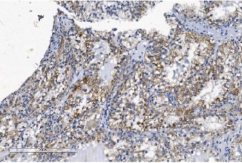 IHC staining of FFPE human renal clear cell carcinoma with KCNQ5 antibody. HIER: boil tissue sections in pH8 EDTA for 20 min and allow to cool before testing.
