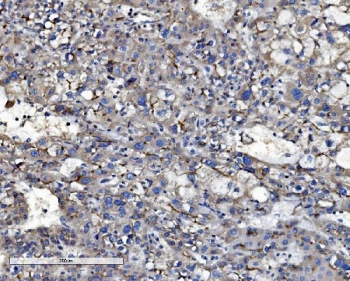 IHC staining of FFPE human liver cancer with ABCB1 antibody. HIER: boil tissue sections in pH8 EDTA for 20 min and allow to cool before testing.