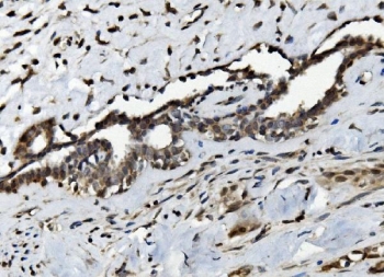 IHC staining of FFPE human breast cancer with Serum Response Factor antibody. HIER: boil tissue sections in pH8 EDTA for 20 min and allow to cool before testing.