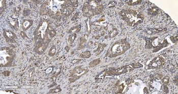 IHC staining of FFPE human gallbladder adenocarcinoma tissue with ARG2 antibody. HIER: boil tissue sections in pH8 EDTA for 20 min and allow to cool before testing.