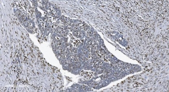 IHC staining of FFPE human ovarian serous adenocarcinoma tissue with SAMHD1 antibody. HIER: boil tissue sections in pH8 EDTA for 20 min and allow to cool before testing.