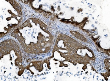 IHC staining of FFPE human ovarian cancer with INPPL1 antibody. HIER: boil tissue sections in pH8 EDTA for 20 min and allow to cool before testing.