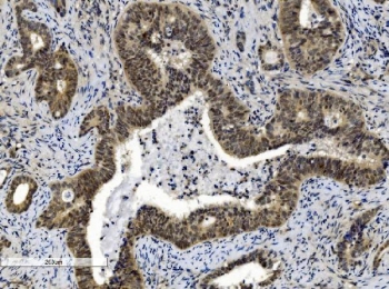 IHC staining of FFPE human gallbladder adenocarcinoma tissue with CBX8 antibody. HIER: boil tissue sections in pH8 EDTA for 20 min and allow to cool before testing.