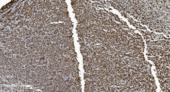 IHC staining of FFPE human lymphoma with Ku70 antibody. HIER: boil tissue sections in pH8 EDTA for 20 min and allow to cool before testing.