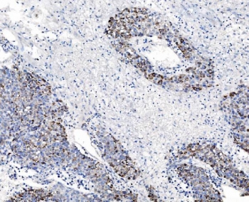 IHC staining of FFPE human liver cancer tissue with CHCHD10 antibody. HIER: boil tissue sections in pH8 EDTA for 20 min and allow to cool before testing.