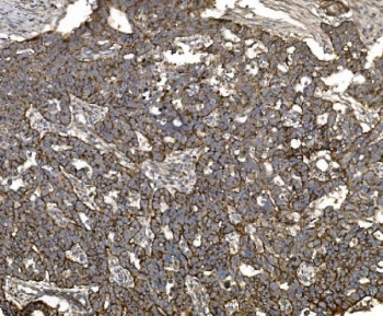 IHC staining of FFPE human ovarian serous adenocarcinoma tissue with Claudin 3 antibody. HIER: boil tissue sections in pH8 EDTA for 20 min and allow to cool before testing.