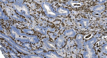 IHC staining of FFPE human gallbladder adenocarcinoma tissue with Coronin 1a antibody. HIER: boil tissue sections in pH8 EDTA for 20 min and allow to cool before testing.