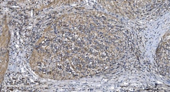 IHC staining of FFPE human gallbladder adenocarcinoma tissue with STIL antibody. HIER: boil tissue sections in pH8 EDTA for 20 min and allow to cool before testing.