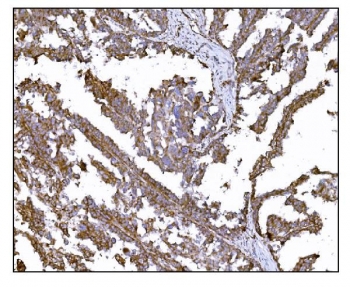 IHC staining of FFPE human ovarian cancer tissue with LRP1B antibody. HIER: boil tissue sections in pH8 EDTA for 20 min and allow to cool before testing.