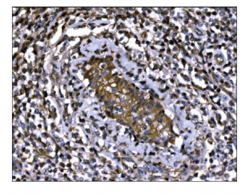 IHC staining of FFPE human gastric cancer tissue with M6PR antibody. HIER: boil tissue sections in pH8 EDTA for 20 min and allow to cool before testing.