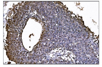 IHC staining of FFPE human liver cancer tissue with COPS5 antibody. HIER: boil tissue sections in pH8 EDTA for 20 min and allow to cool before testing.