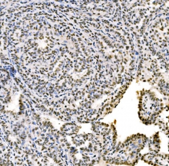 IHC staining of FFPE human Hashimoto's thyroiditis tissue with SSB antibody. HIER: boil tissue sections in pH8 EDTA for 20 min and allow to cool before testing.