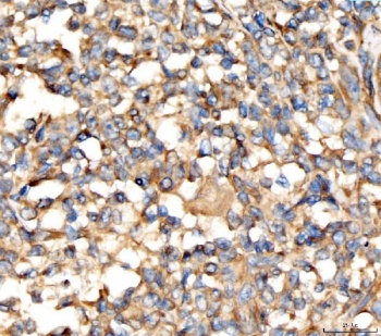 IHC staining of FFPE human lymphoma tissue with AP2A2 antibody. HIER: boil tissue sections in pH8 EDTA for 20 min and allow to cool before testing.