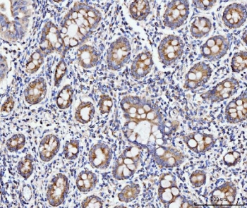 IHC staining of FFPE human gastric adenocarcinoma tissue with ECSIT antibody. HIER: boil tissue sections in pH8 EDTA for 20 min and allow to cool before testing.