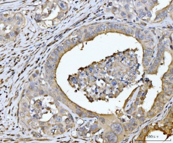 IHC staining of FFPE human appendiceal adenocarcinoma tissue with EDEM3 antibody. HIER: boil tissue sections in pH8 EDTA for 20 min and allow to cool before testing.