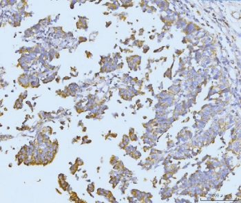 IHC staining of FFPE human colonic adenocarcinoma tissue with ETFA antibody. HIER: boil tissue sections in pH8 EDTA for 20 min and allow to cool before testing.