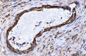 IHC staining of FFPE human gall bladder adenosquamous carcinoma tissue with GIGYF2 antibody. HIER: boil tissue sections in pH8 EDTA for 20 min and allow to cool before testing.