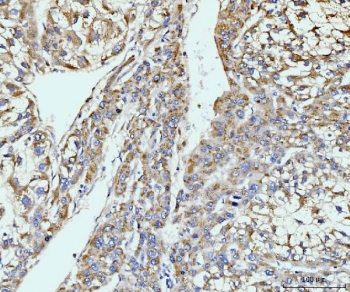IHC staining of FFPE human liver cancer tissue with GIT1 antibody. HIER: boil tissue sections in pH8 EDTA for 20 min and allow to cool before testing.