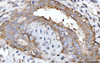 IHC staining of FFPE human breast cancer tissue with GNB3 antibody. HIER: boil tissue sections in pH8 EDTA for 20 min and allow to cool before testing.
