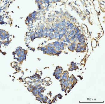 IHC staining of FFPE human colonic adenocarcinoma tissue with GRPEL1 antibody. HIER: boil tissue sections in pH8 EDTA for 20 min and allow to cool before testing.