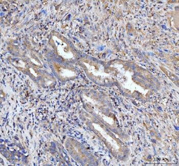 IHC staining of FFPE human gall bladder adenosquamous carcinoma tissue with PDLIM7 antibody. HIER: boil tissue sections in pH8 EDTA for 20 min and allow to cool before testing.