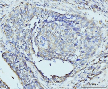 IHC staining of FFPE human lung cancer tissue with RPL23 antibody. HIER: boil tissue sections in pH8 EDTA for 20 min and allow to cool before testing.