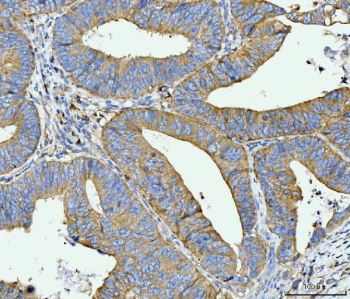 IHC staining of FFPE moderately differentiated adenocarcinoma of human rectum tissue with ACSL4 antibody. HIER: boil tissue sections in pH8 EDTA for 20 min and allow to cool before testing.