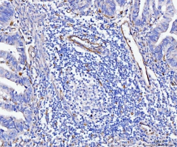 IHC staining of FFPE human gastric adenocarcinoma tissue with CD93 antibody. HIER: boil tissue sections in pH8 EDTA for 20 min and allow to cool before testing.