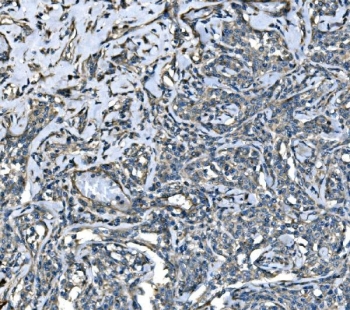 IHC staining of FFPE human lymphoma tissue with Atlastin-1 antibody. HIER: boil tissue sections in pH8 EDTA for 20 min and allow to cool before testing.