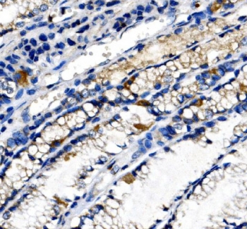 IHC staining of FFPE human gastric cancer tissue with Ghrelin antibody. HIER: boil tissue sections in pH8 EDTA for 20 min and allow to cool before testing.