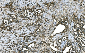 IHC staining of FFPE human stomach cancer tissue with RAB13 antibody. HIER: boil tissue sections in pH8 EDTA for 20 min and allow to cool before testing.
