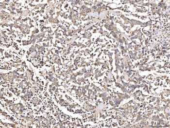IHC staining of FFPE human pancreatic cancer tissue with AGT antibody. HIER: boil tissue sections in pH8 EDTA for 20 min and allow to cool before testing.